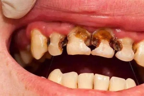 通过八字解析牙齿健康的奥秘 通过八字解析牙齿健康的奥秘
