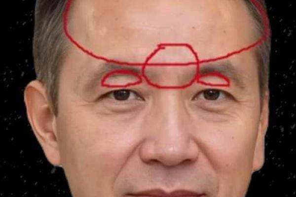 如何通过额头疤痕判断未来运势 如何通过额头疤痕判断未来运势