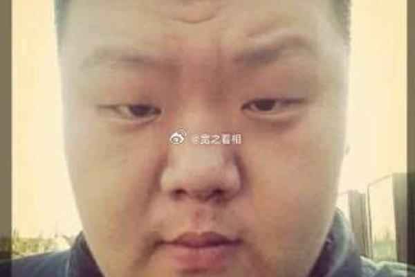 从额头疤痕看命运起伏与运势走向 从额头疤痕看命运起伏与运势走向